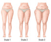 Classification en stades des distinctions morphologiques