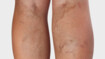 Legs with varicose veins