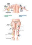 Lipödem Symptome