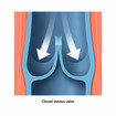 Closed venous valve