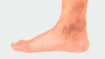 Foot with chronic venous insufficiency