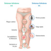 Los síntomas de un linfedema